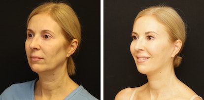facelift before and after photos