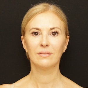 facelift surgery results 