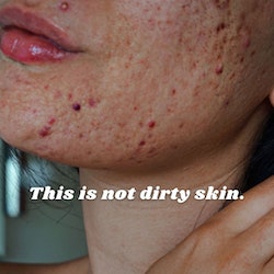 acne skin care influencer
